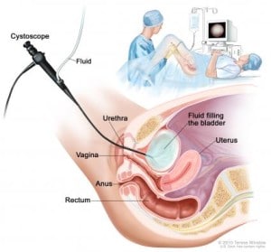 cytoscopy-300x279 cytoscopy