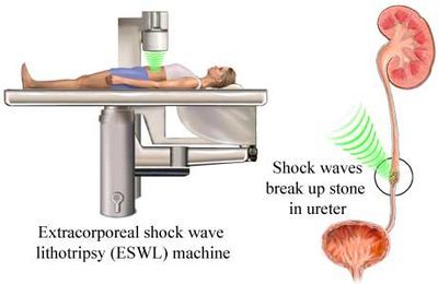 lithotripsy prostatitis